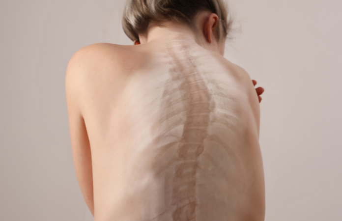 young woman's back with scoliosis