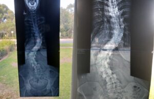 scoliosis x-rays
